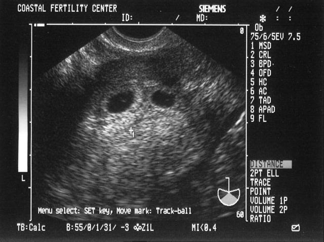 4/22/05
Oh my God, there are two in there!