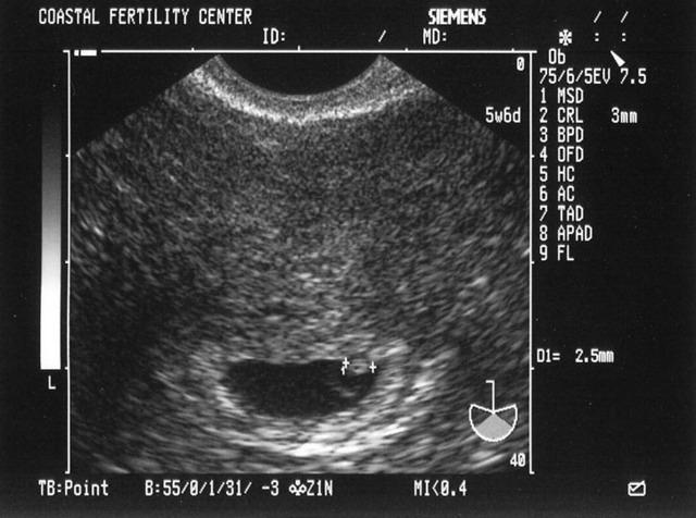 4/26/05
Baby B - 5w6d
