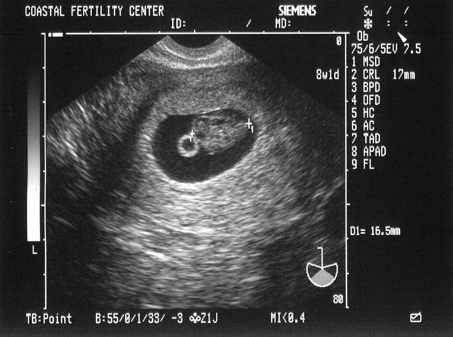 5/10/05
Baby A - 8w1d