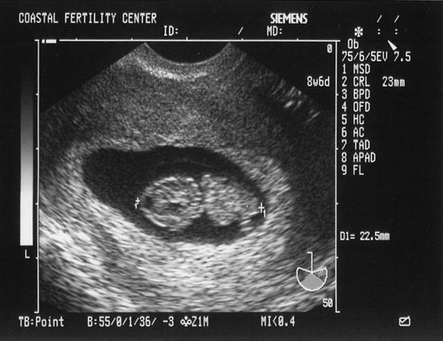 5/17/05
Baby B - 8w6d