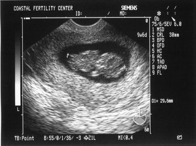 5/23/05
Baby B - 9w6d