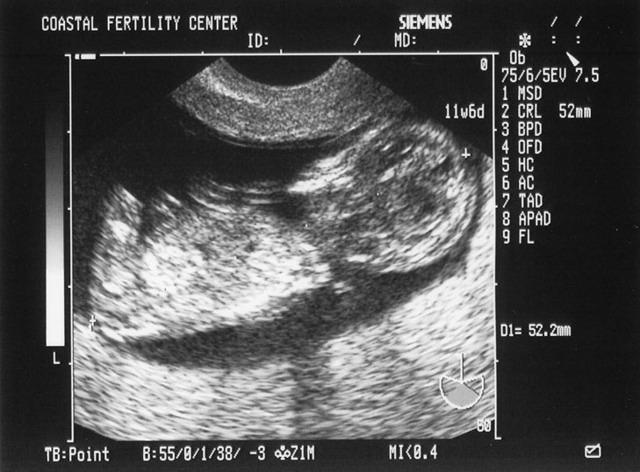 6/7/05
Baby A - 11w6d