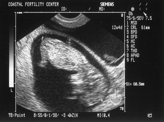 6/7/05
Baby B - 12w4d
