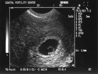 4/26/05
Baby A - 5w6d