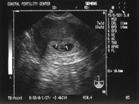 5/3/05
Baby A - 7w1d
