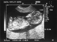 6/7/05
Baby A - 11w6d